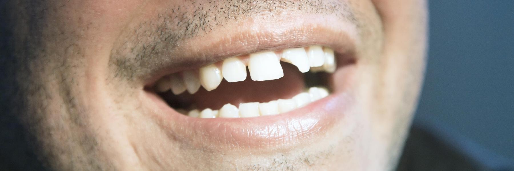 Crowns and Bridges | Dentist