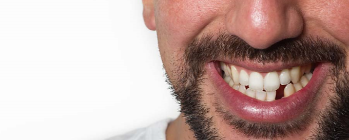 Dental Implants | Dentist
